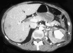 Av Fistulae in Left Kidney S/P Partial Nephrectomy - CTisus CT Scan