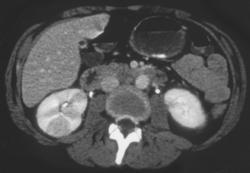 Acute Pyelonephritis - CTisus CT Scan