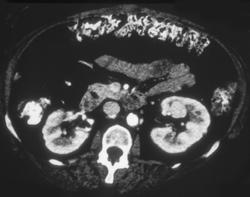 Subtle Left Hypervascular Renal Cell Carcinoma - CTisus CT Scan