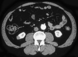 Multiple Renal Cell Carcinomas - CTisus CT Scan