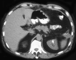 Stent Accidentally Goes Through Left Renal Pelvis - CTisus CT Scan