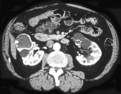 Calcified Renal Cyst - CTisus CT Scan