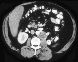 Recurrent Renal Cell With Nodes - CTisus CT Scan