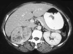 Acute Pyelonephritis - CTisus CT Scan