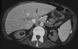 Poorly Functioning Kidneys - CTisus CT Scan