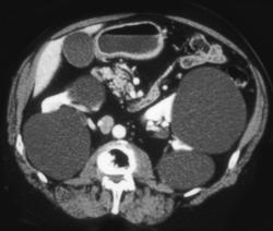 Renal Cysts - CTisus CT Scan