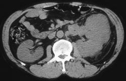 Renal Cell Carcinoma - CTisus CT Scan