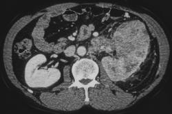 Renal Cell Carcinoma Invades Renal Vein - CTisus CT Scan