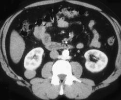 Renal Cell Carcinoma - CTisus CT Scan