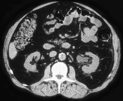 Stone in Distal Left Ureter - CTisus CT Scan