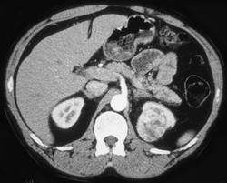 Incidental Renal Cell in A Potential Renal Donor - CTisus CT Scan