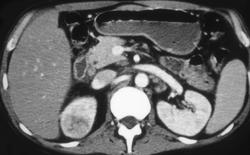 Acute Pyelonephritis - CTisus CT Scan