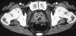 Prostate Abscess - CTisus CT Scan