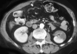 Renal Infarct - CTisus CT Scan