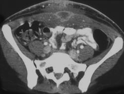 Abscess Involving Urachal Remnant - CTisus CT Scan