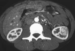 Renal Cell Carcinoma - CTisus CT Scan