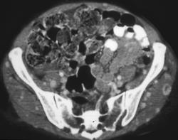 Metastases to Muscle From A Renal Sarcoma - CTisus CT Scan