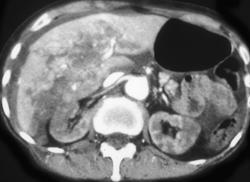 Liver Laceration S/P Trauma With Decreased Renal Function - CTisus CT Scan