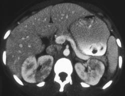 Acute Pyelonephritis - CTisus CT Scan