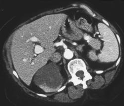 Cystic Nephroma - CTisus CT Scan