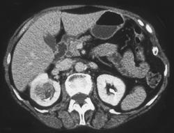 Transitional Cell Carcinoma - CTisus CT Scan