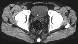 Recently Passed Stone Into the Bladder - CTisus CT Scan