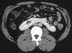 Horseshoe Kidney - CTisus CT Scan