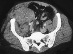 Renal Transplant Rejection - CTisus CT Scan