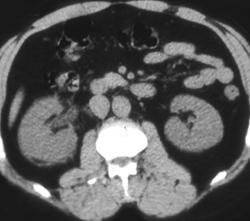 Stones in Distal Ureter - CTisus CT Scan