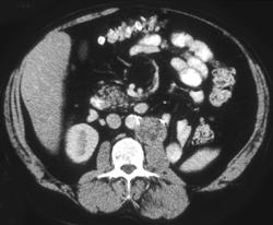 Recurrent Nodes Following Left Renal Nephrectomy for Cancer - CTisus CT Scan