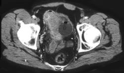 Bladder Cancer - CTisus CT Scan