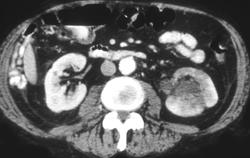 Renal Lymphoma - CTisus CT Scan