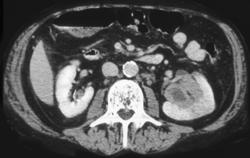 Renal Lymphoma Simulates A Transitional Cell Carcinoma - CTisus CT Scan