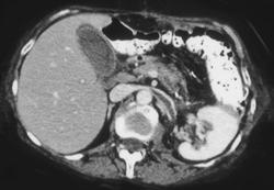 Left Renal Vein Thrombosis - CTisus CT Scan