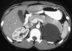 Adrenal Cyst Simulates A Renal Cyst - CTisus CT Scan