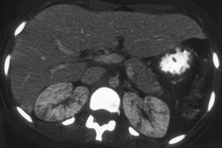 Acute Pyelonephritis - CTisus CT Scan