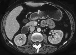 Acute Pyelonephritis - CTisus CT Scan