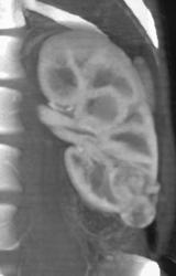 Renal Cell Carcinoma - CTisus CT Scan