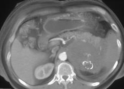 Renal Lymphoma - CTisus CT Scan