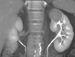 Renal Cell Carcinoma - CTisus CT Scan