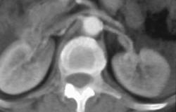 Calcification Near Origin of the Left Renal Artery - CTisus CT Scan