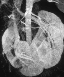 Horseshoe Kidney - CTisus CT Scan