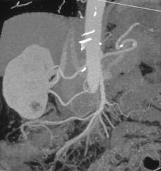 VRT and MIP of Renal Arteries - CTisus CT Scan