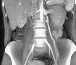 Prominent Left Gonadal Vein - CTisus CT Scan