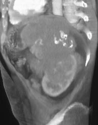 Renal Lymphoma - CTisus CT Scan