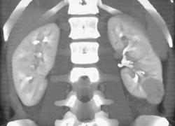 Renal Carcinoma - CTisus CT Scan