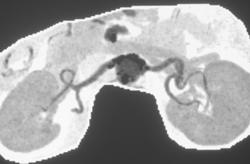 Calcification of the Origin of the Renal Arteries - CTisus CT Scan