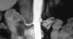 Calcification Near the Origin of the Left Renal Artery - CTisus CT Scan