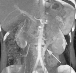 Retroaortic Left Renal Vein - CTisus CT Scan