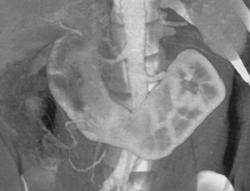 Horseshoe Kidney - CTisus CT Scan